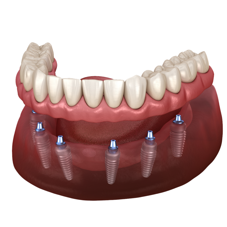 Dental Implants Rochester Ny Same Day Smile Full Arch All On 4