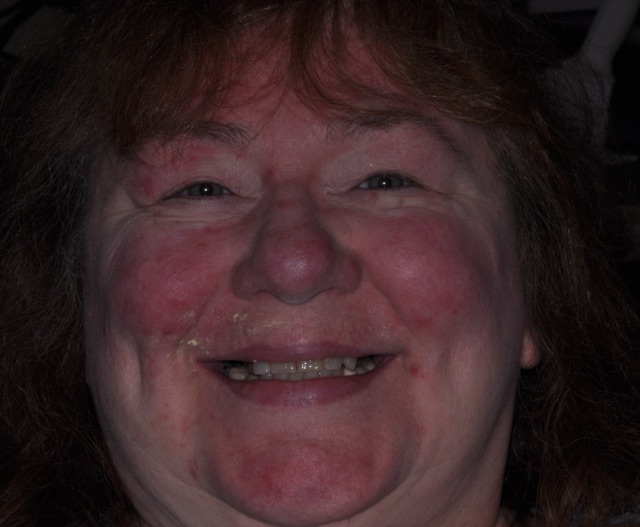 Karen M. before treatment
