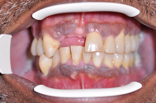 T. Kakuda before treatment