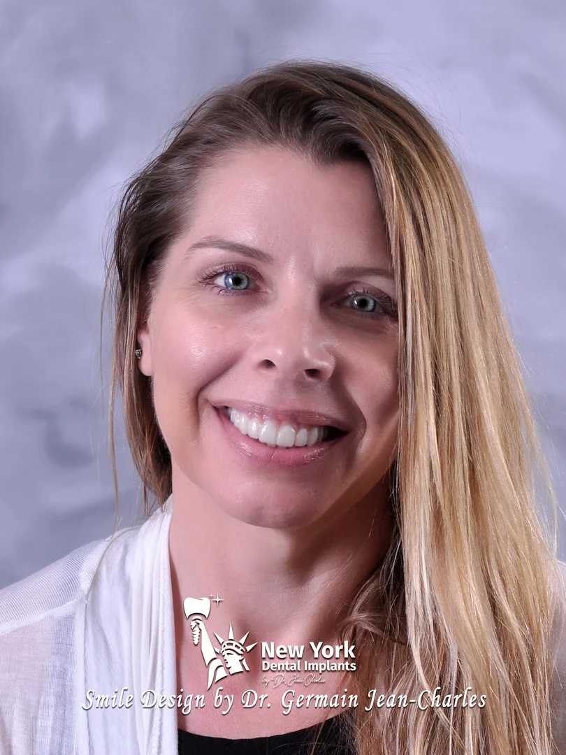 Marie D. after multiple implants treatment at New York Dental Implants