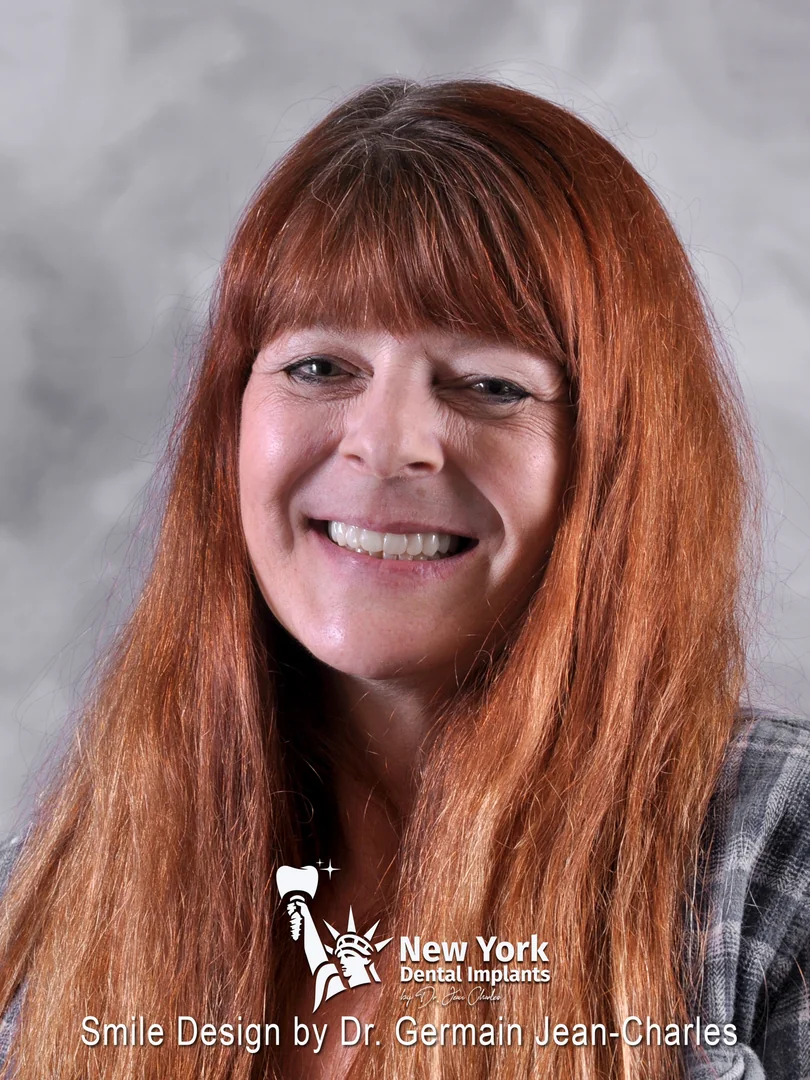 Jean W. after all-on-4 treatment at New York Dental Implants