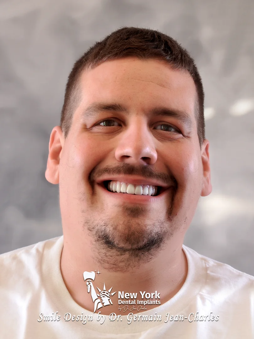 William L. after complete restoration treatment at New York Dental Implants