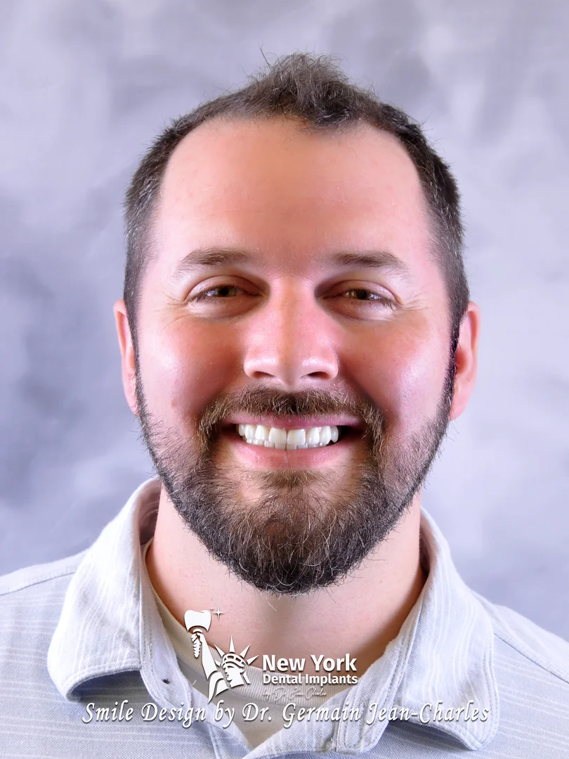 Noah A. after smile makeover treatment at New York Dental Implants