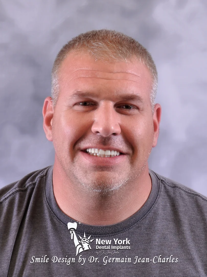 Todd R. after full mouth restoration treatment at New York Dental Implants