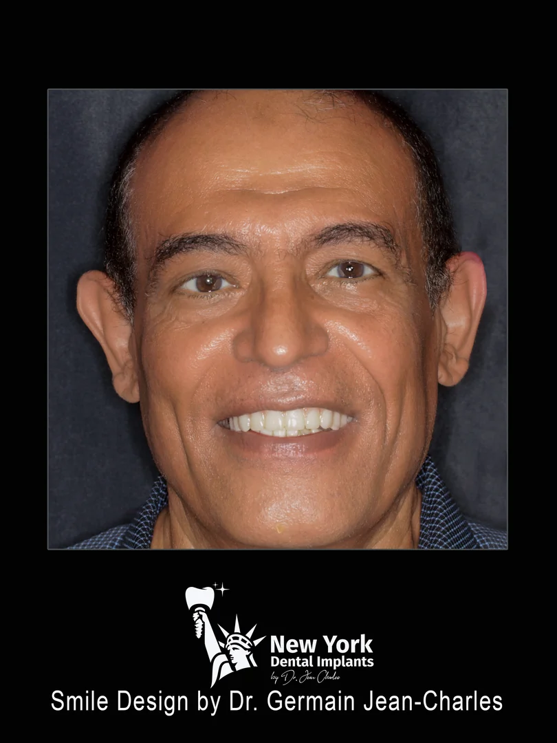 Saleh E. after complete restoration treatment at New York Dental Implants