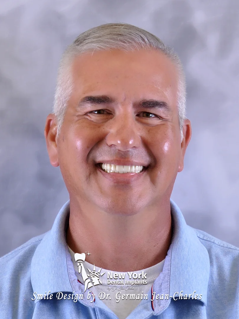 Brad S. after full arch restoration treatment at New York Dental Implants