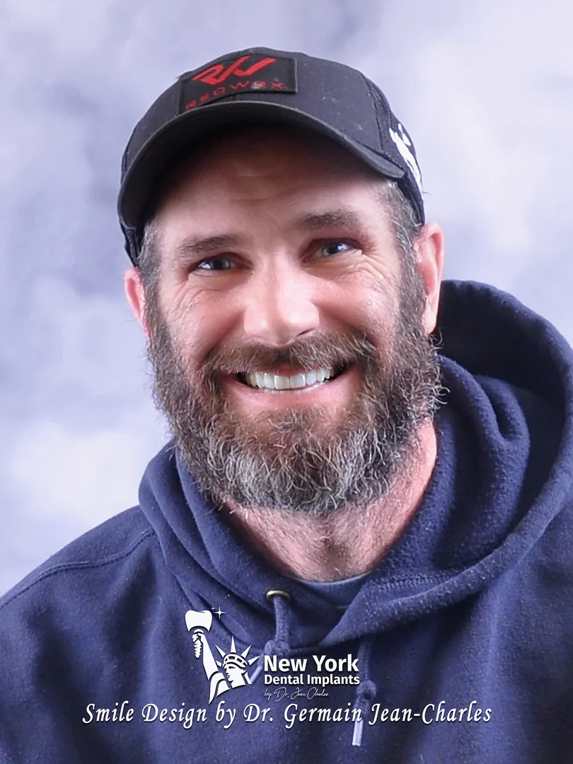Andy S. after multiple implants treatment at New York Dental Implants