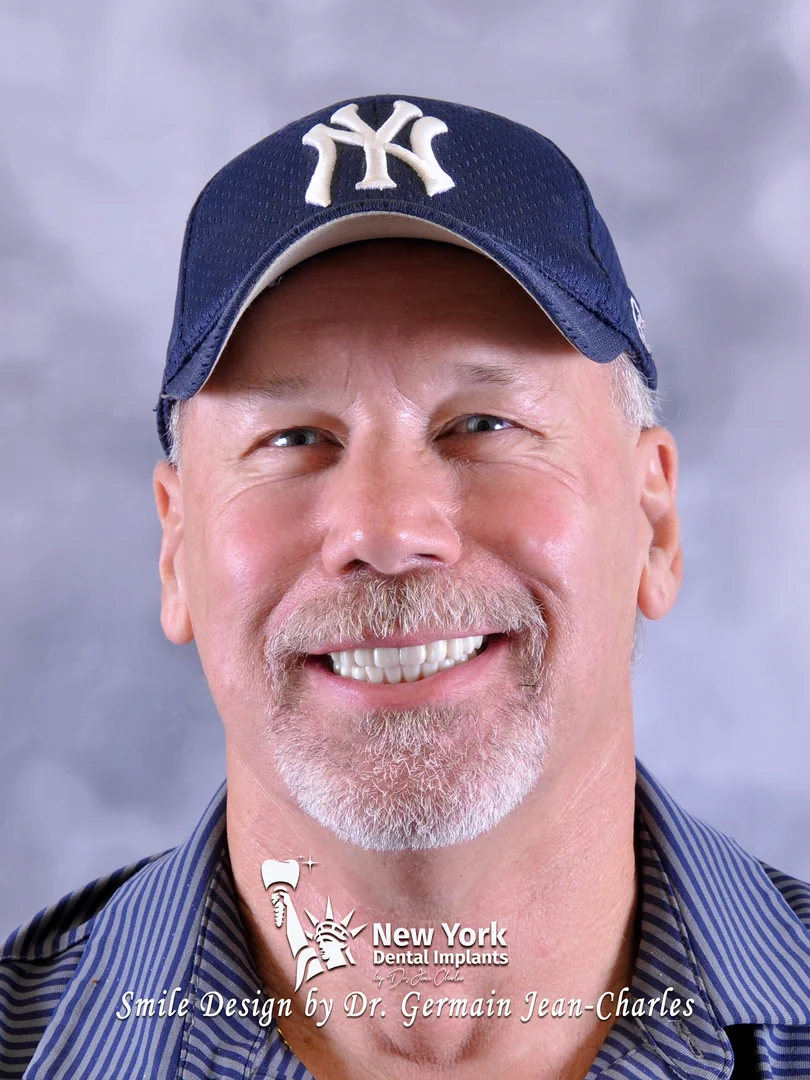 Sean S. after all-on-4 treatment at New York Dental Implants